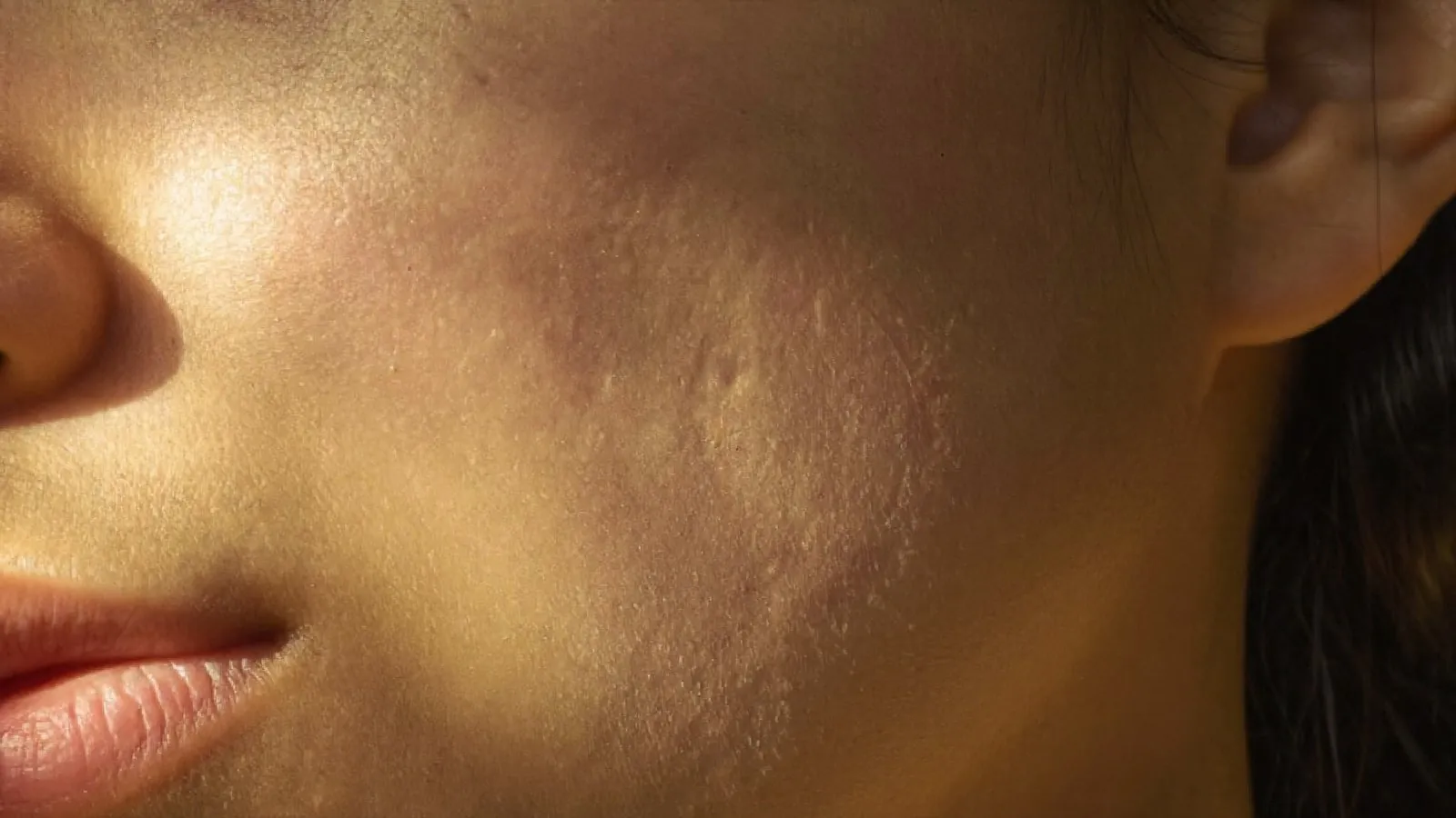 Dr Sin Yong examining acne scar morphology under directed clinical lighting in Singapore