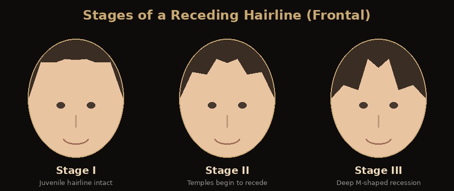 Stages of a receding hairline, viewed from the front