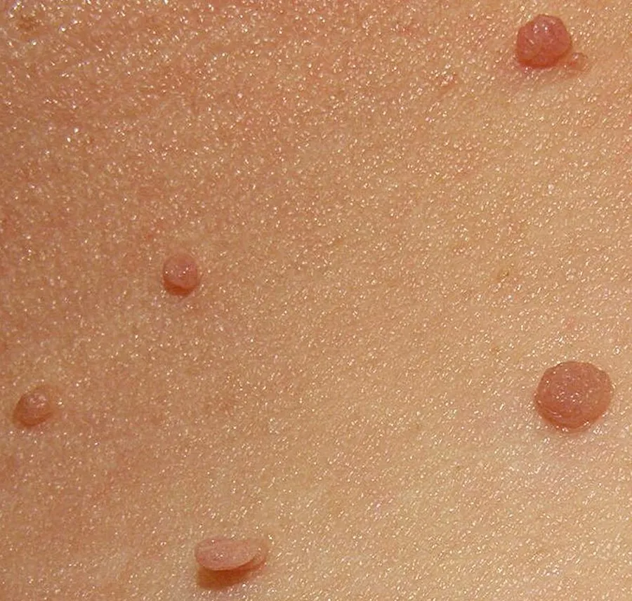 Multiple skin tags on the neck