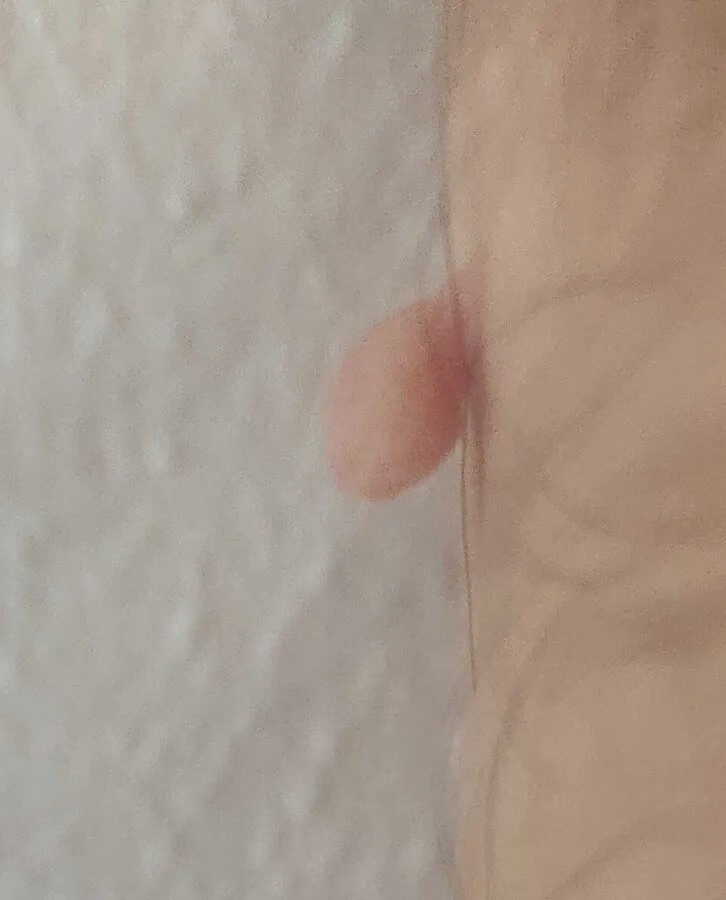 A soft pedunculated skin tag (acrochordon)