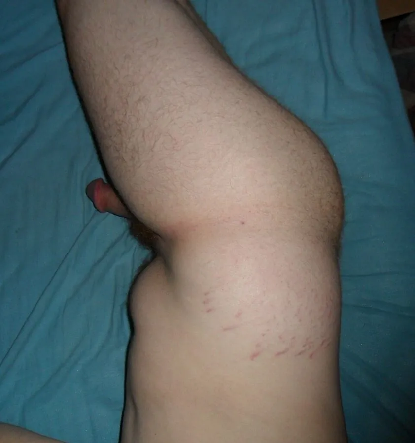Striae over the hip and buttock