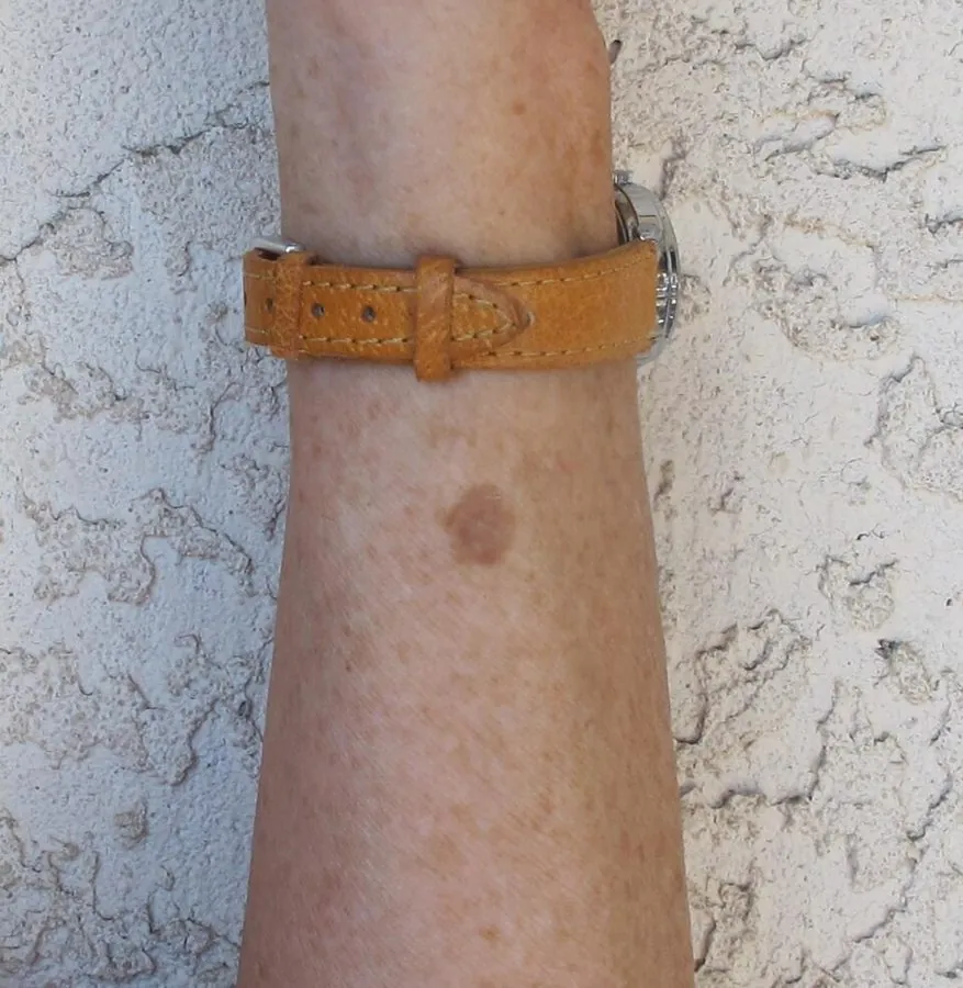 A solar lentigo on the forearm
