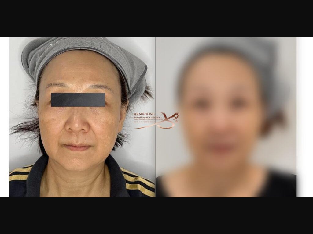 FSX Flawless Smooth Laser — Lifting & Melasma