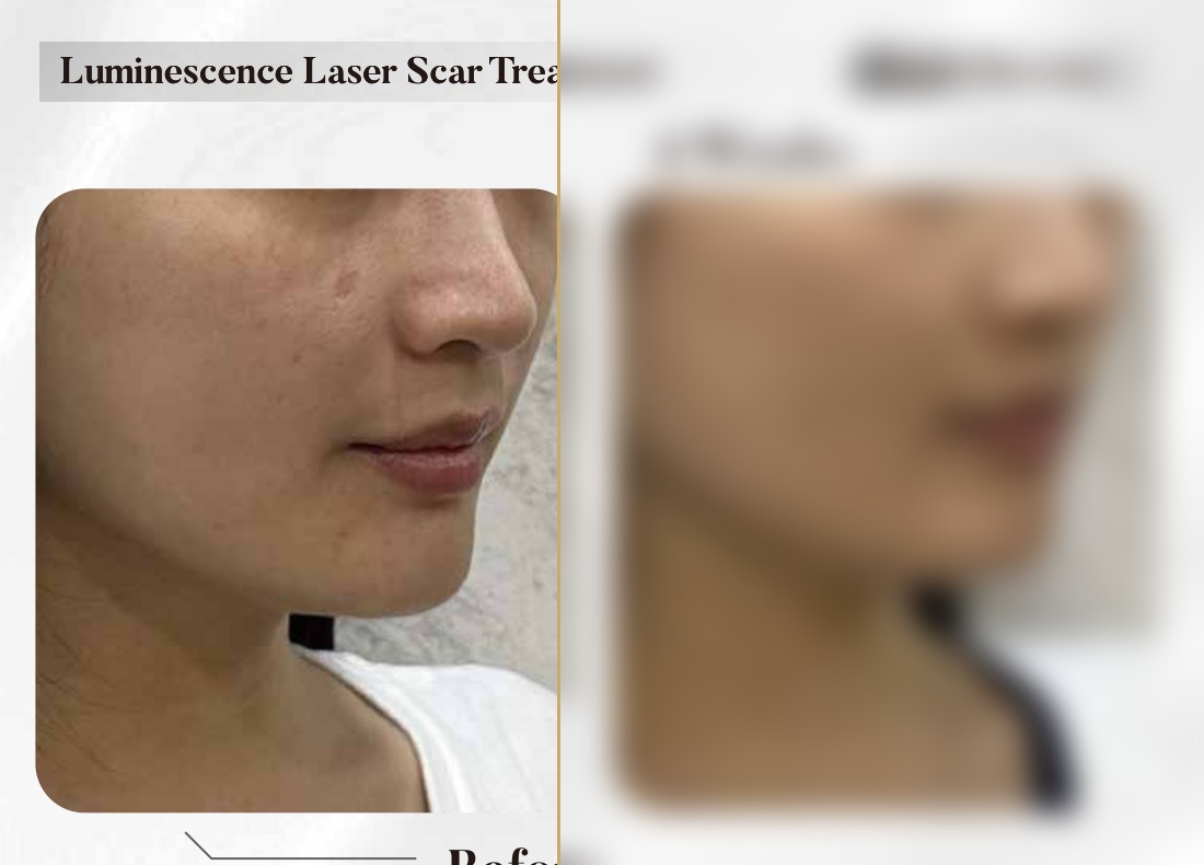 Luminescence Laser — Scar Treatment, 4 Weeks (Single Session)