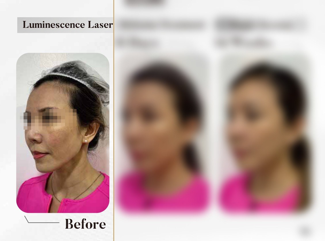Luminescence Laser — Melasma Treatment, 6 Days & 14 Weeks (Single Session)