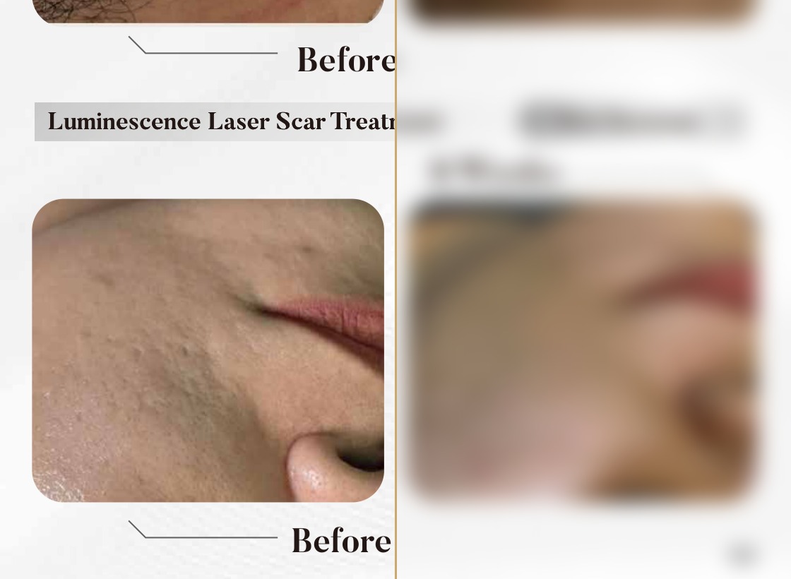 Luminescence Laser — Scar Treatment, 8 Weeks (Two Sessions)