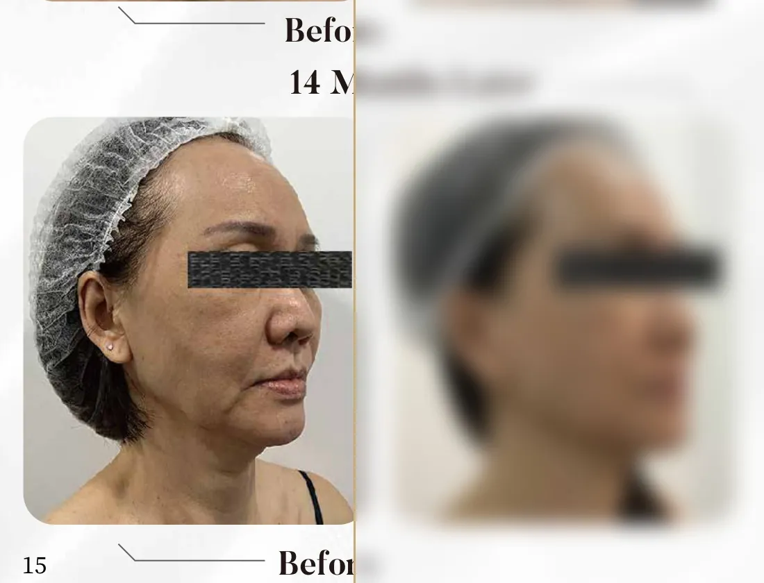 Time Freeze Laser Lift — 14 Months Later, Profile (Single Session)