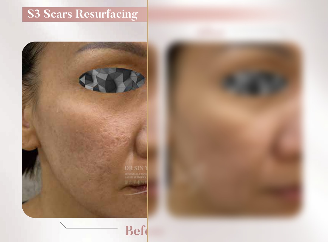 S3 Resurfacing Lift Laser — Scars Resurfacing