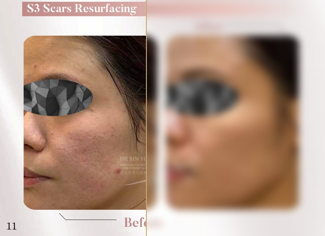 S3 Resurfacing Lift Laser — Scars Resurfacing