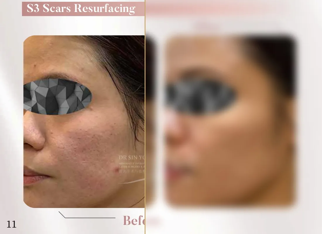 S3 Resurfacing Lift Laser — Scars Resurfacing