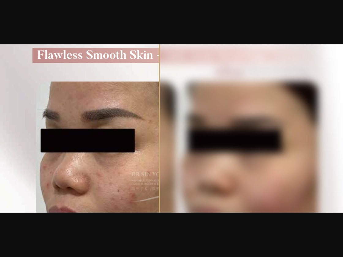 FSX Laser — Anti Acne Scarring