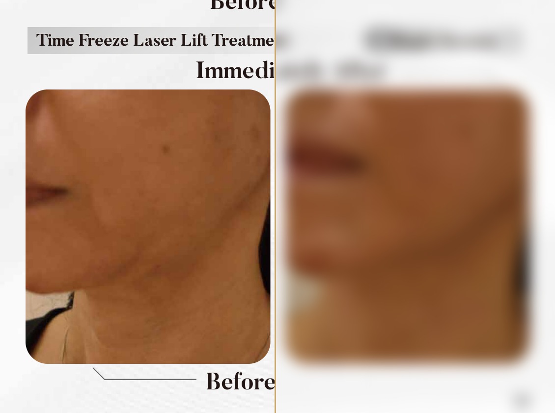 Time Freeze Laser Lift — Immediately After, Skin Close-Up (Single Session)