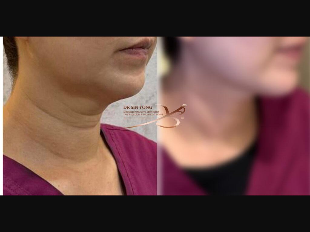 Tetra Pro Scar3 — Neck Lift Treatment & Jawline Definition
