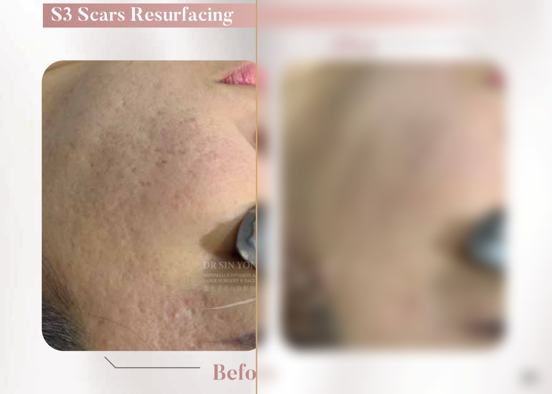 S3 Resurfacing Lift Laser — Scars Resurfacing