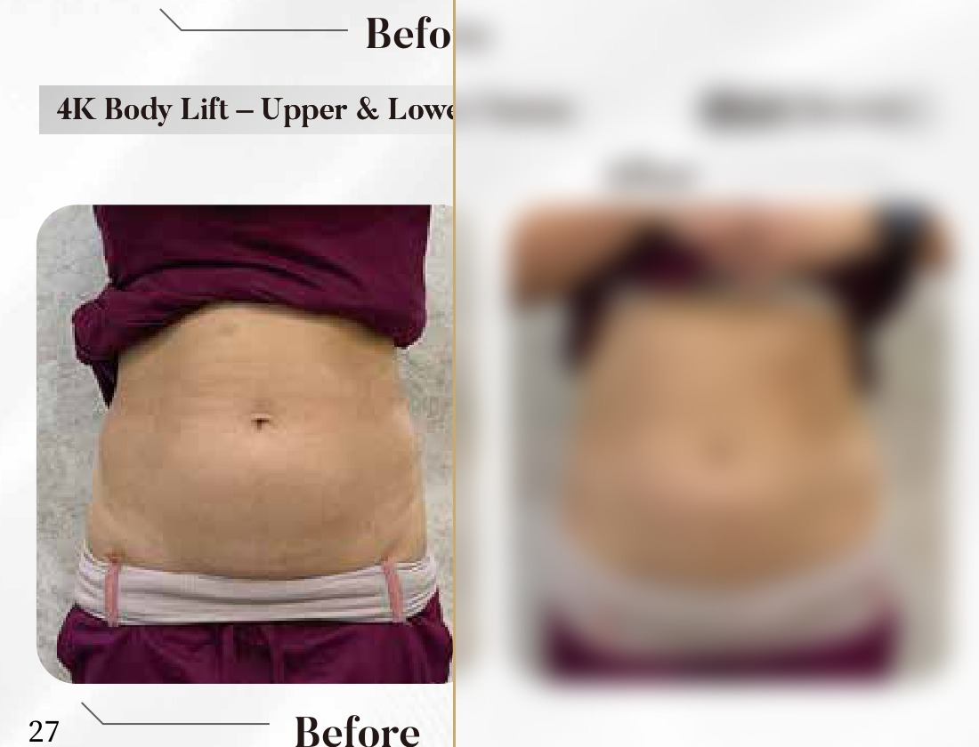 4K Body Lift — Upper & Lower Tummy (Single Session)