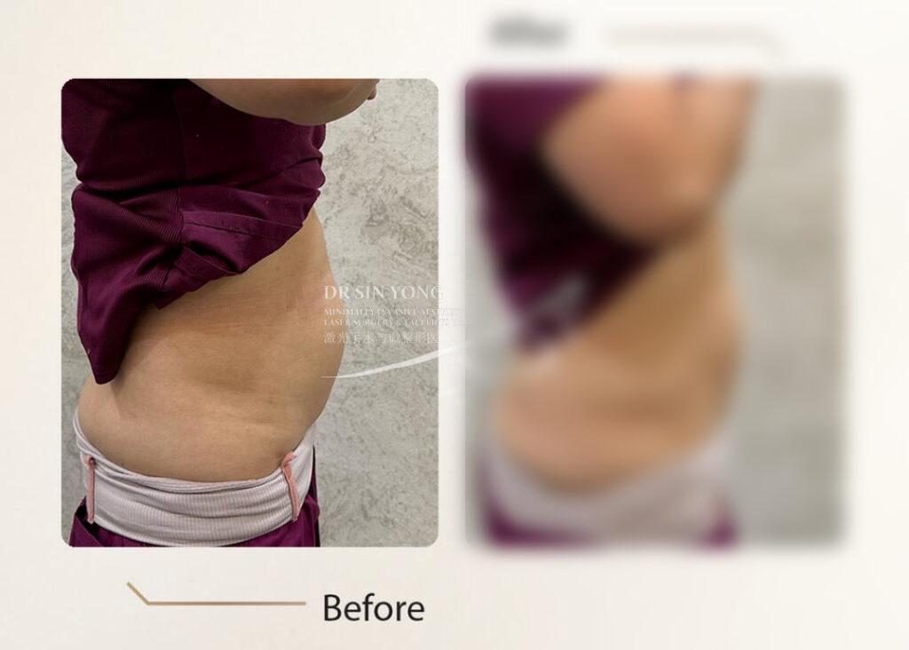4K Body Lift — Tummy Contouring
