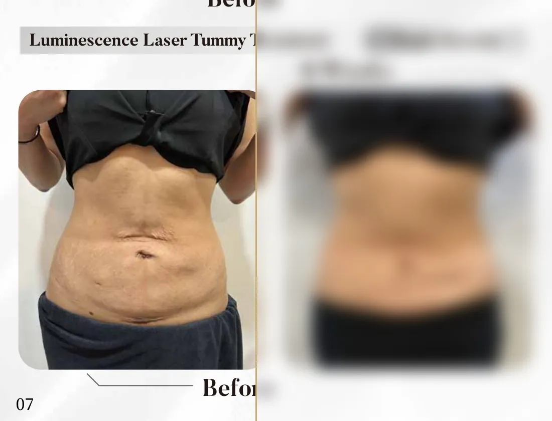 Luminescence Laser — Tummy Treatment, 8 Weeks (Single Session)