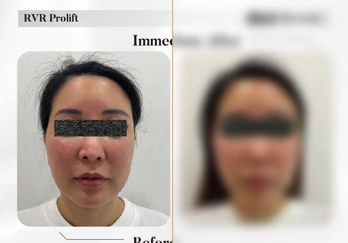 RVR ProLift — Immediately After (Single Session)