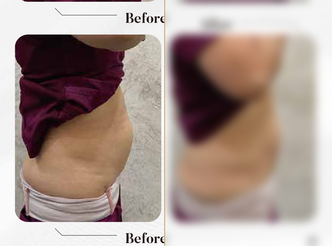 4K Body Lift — Upper & Lower Tummy Side View (Single Session)