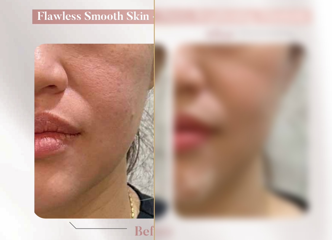 FSX Laser — Pores, Brightening & Elasticity