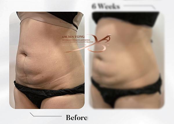 Time Freeze Laser Lift LCLR — Tummy Slimming