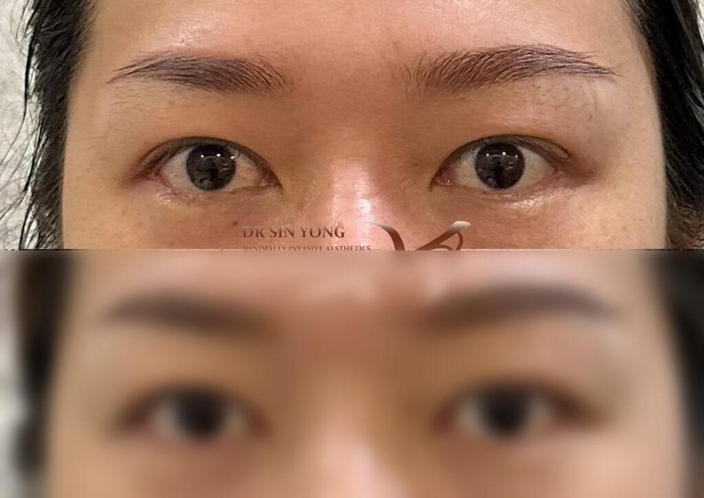FSX Flawless Smooth Laser — Non Surgical Eye Lift for Droopy Eyelids