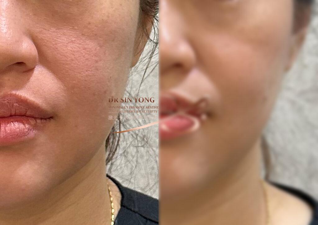 FSX Flawless Smooth Laser — Pores & Lifting