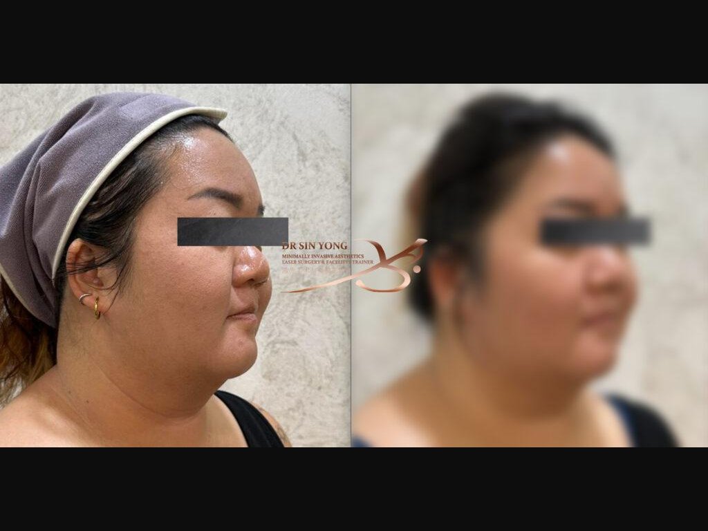Tetra Pro Scar3 — Face Lift Treatment