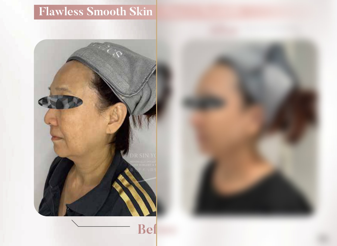 FSX Laser — Face & Necklift
