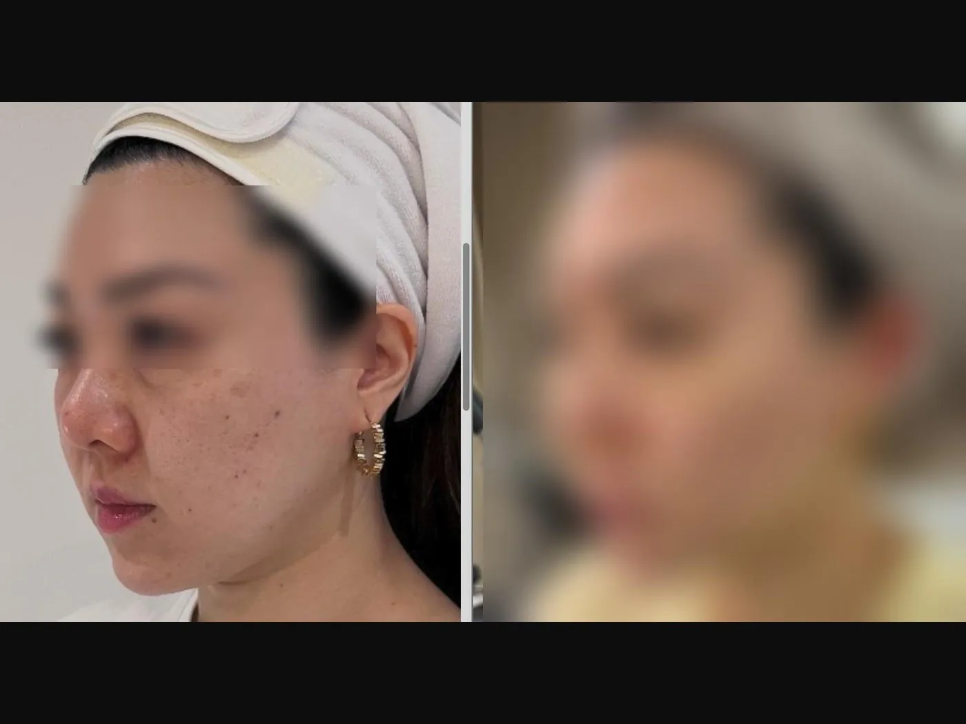 VF Facelift - Highlighting Jawline Definition