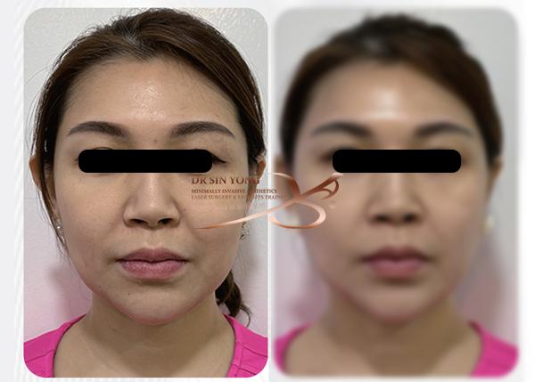 Time Freeze Laser Lift LCLR — Facelift