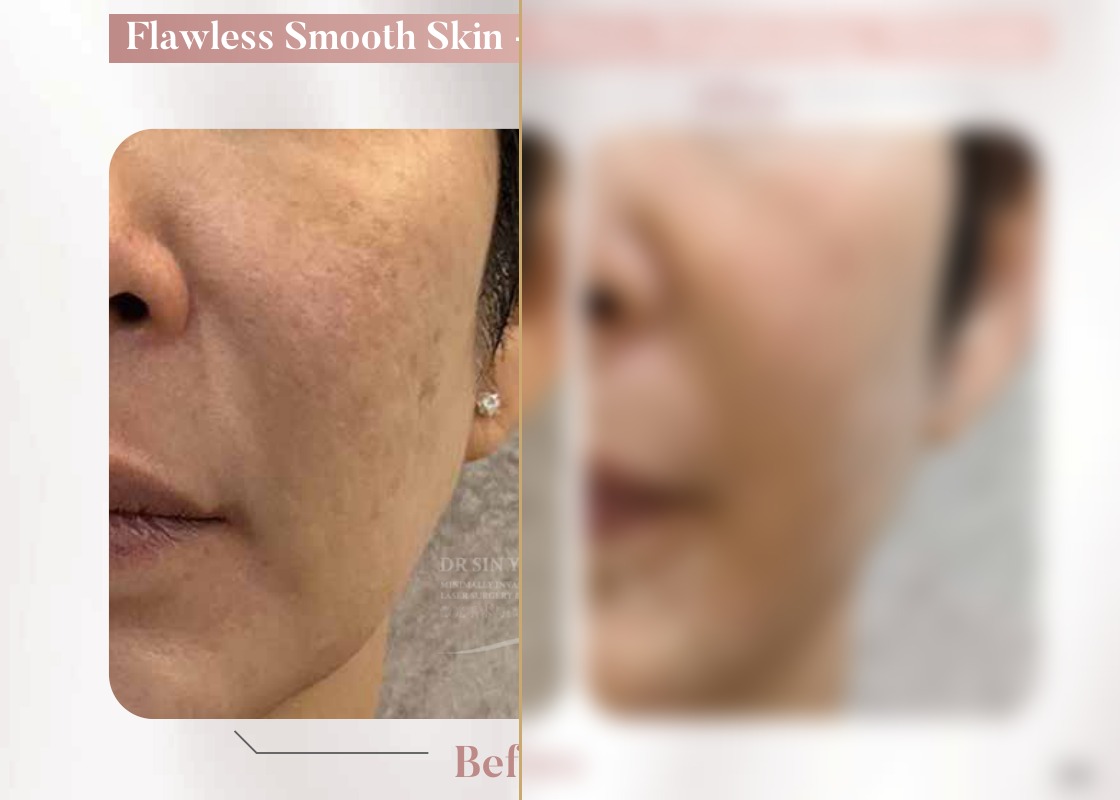 FSX Laser — Pores, Brightening & Melasma