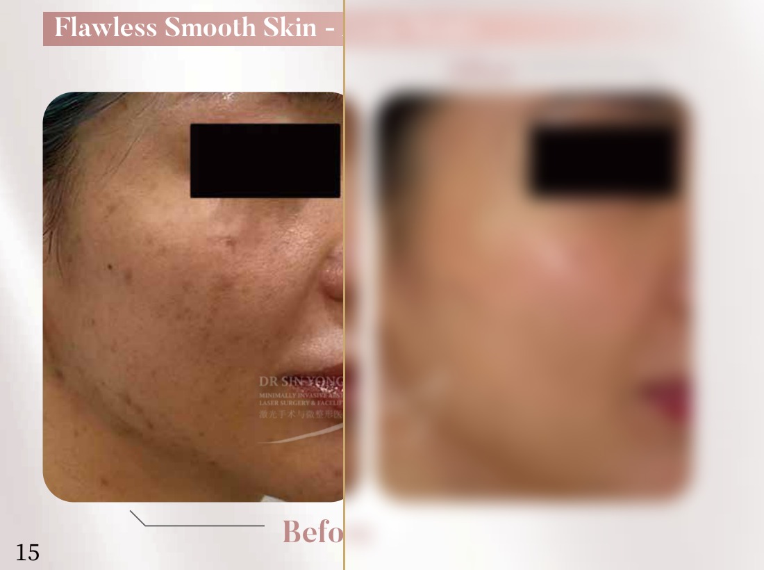 FSX Laser — Acne Scars